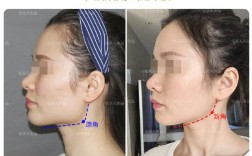 骨性正畸能变脸型吗