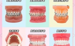 矫正牙齿的材料哪种比较好？