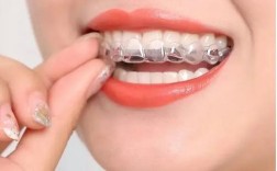 成都隐形正畸温馨春天，隐形正畸效果怎么样？