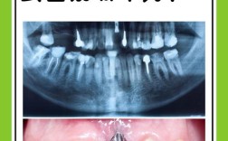 镶牙和种牙选东莞拜博？哪种方式更适合你的口腔需求？