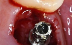 植体邻牙有牙髓炎