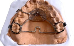 正畸横腭杆制作步骤