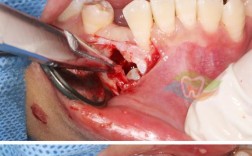 正畸治疗过程中牙周组织损害的常见类型有哪些？如何科学预防与处理？