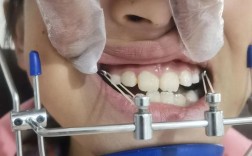 面弓矫正的使用方法是什么？正确操作步骤与注意事项详解