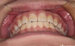 正畸拔牙会导致颧骨变高吗？