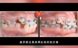 隐形虎牙矫正效果如何？隐形矫正能解决虎牙问题吗？