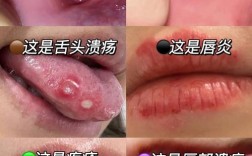 口腔炎有哪些有效的治疗方法及适用情况？