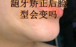 下颌偏移正畸可以吗
