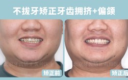 正畸前牙往后收5mm，效果如何实现？