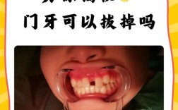 龅牙患者是否需要拔掉牙齿再进行种植牙修复？