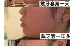 牙齿矫正前后对照图，为何变化效果如此显著？