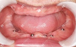 广州省口腔植牙多少钱？效果好不好？医院怎么选靠谱？