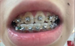 金属过敏者能做牙齿正畸吗？材料会引发过敏吗？