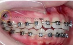 牙齿正畸支坑钉多少钱