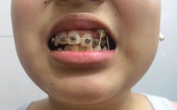 先天缺失下前牙，正畸如何兼顾功能与美观？