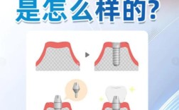 牙槽骨厚度多少毫米适合种牙？
