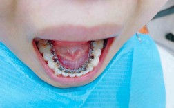 正畸总是咬舌头一侧