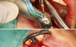 种牙植骨后线自己掉了