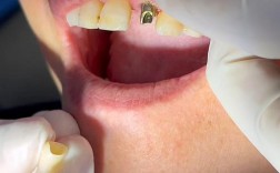 真实的种植牙感觉怎样？能和真牙一样好用吗？