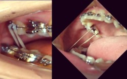 正畸调整中线牵引后头疼是什么原因引起的？