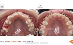 龋齿很严重可以正畸么