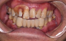 做正畸牙齿松动