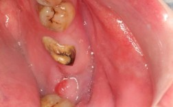 种牙术后口腔内出现血块属于正常术后反应吗？