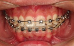 成人矫正牙套效果好吗？适合哪些情况？