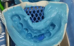 可摘局部义齿取模方法