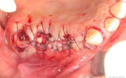 种牙植骨创伤面