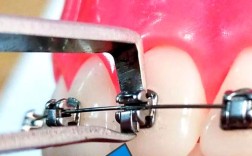 正畸托槽间接粘接技术相较于传统直接粘接，如何通过模型转移提升托槽定位精准度？对复杂病例矫正效果有何影响？