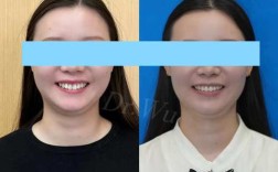 成人正畸只能选隐形矫正吗？