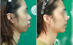 嘴凸矫正前后对比图片真实吗？