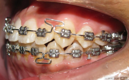 kq88口腔正畸图片