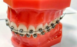 正畸托槽哪种最舒适？不同托槽舒适度怎么选？