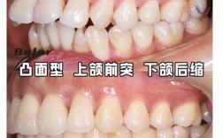牙齿矫正上颚图片能看懂哪些矫正关键变化？