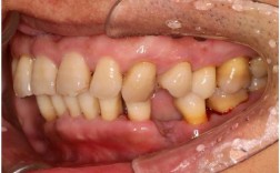 正畸期间发现牙周病，矫正会加重病情吗？如何兼顾治疗？