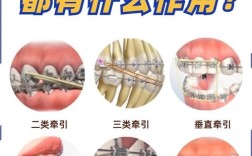 牙齿矫正二类牵引，作用、效果及注意事项？