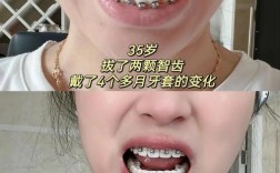 35岁矫正牙齿还适合吗？成年人矫正来得及吗？