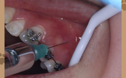 矫正牙齿为何要拔牙？拔牙是必要步骤吗？