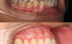 正畸j钩危害照片真实吗？是否反映实际风险？