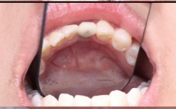 南京微创种牙哪家好？价格和效果如何？