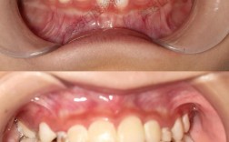 正畸中后牙反合