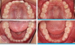 儿童前牙反颌正畸的最佳矫治时机是什么时候？