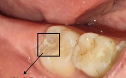 正畸后为何全口牙都蛀了？矫正过程藏隐患？