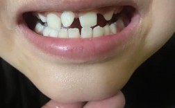 牙齿矫正门牙歪，是矫正器选错还是术后护理没到位？