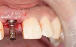 种牙骨高度不足，植骨为何必不可少？