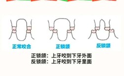 正畸锁颌治疗的最佳方法是什么？