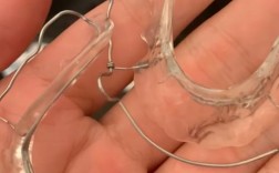 牙齿矫正门牙松动，是正常现象还是需警惕的问题？