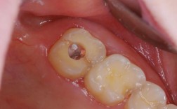 牙槽突裂的治疗方法有哪些？不同修复方式的效果与适用情况如何？